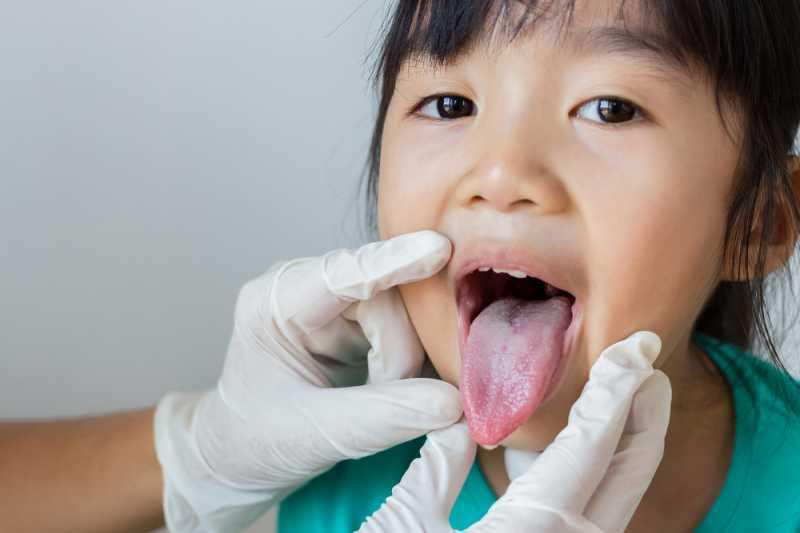 Oral Thrush, Infeksi Jamur di Mulut yang Bisa Menyerang Bayi dan Orang Dewasa