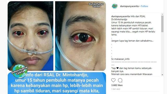 Pembuluh Darah Matanya Pecah karena Main Ponsel?